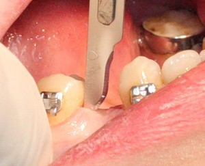 Разрезы при прорезывании зубов