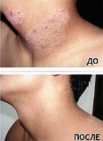 Мазь от псориаза Король кожи