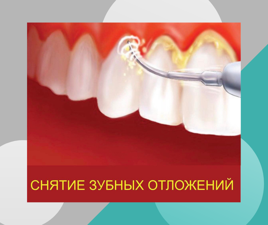 Ультразвуковая чистка зубов - фото 1 - id-p57279640