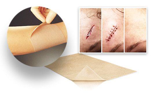 Переваги пластиру Мепиформ Мепиформ / MEPIFORM - 5cm*7,5 cm - самоклеюча пов'язка з покриттям з м'якого силікону для догляду за рубцями., ціна 3000 Тг., купити Нур - Султан — Satu.kz (ID#70030364)