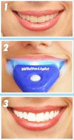 Cистема для отбеливания зубов "White Light" - фото 1 - id-p70349000