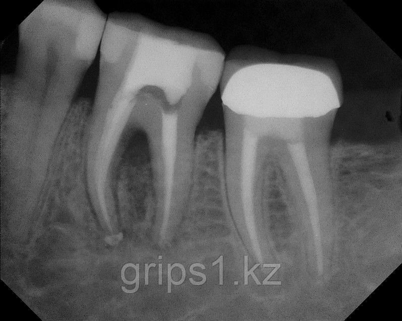 Прицельный снимок зуба. Периодонтит вкладка рентген. Штифтовая культевая вкладка рентген. Культевая вкладка зуба рентген. Прицельный снимок периодонтит.