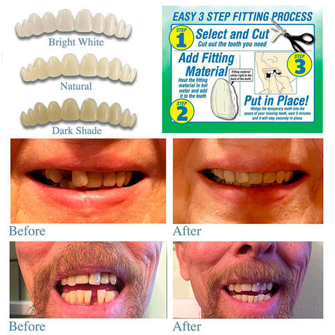 Набор временных зубов-виниров Smile Temporary Tooth Kit - фото 2 - id-p70991725