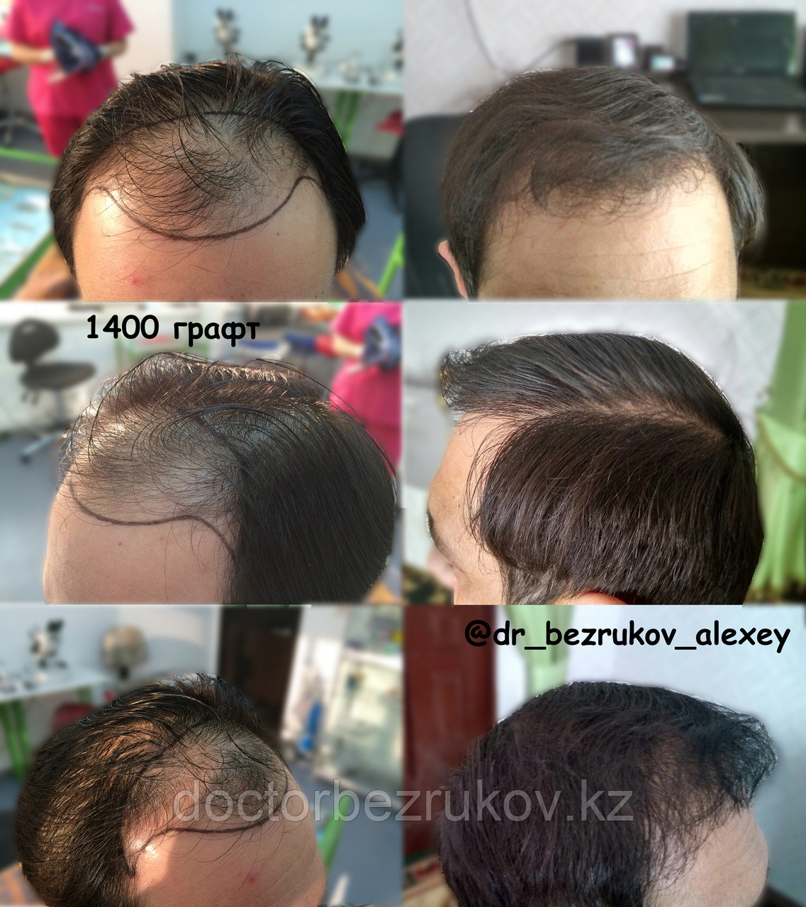 1 графт сколько волос. 1 графт сколько волос. 2 месяца после пересадки волос. Как выглядят 3000 графтов. Трансплантация волос методом fue.