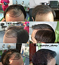 Трансплантация волос Алматы, фото 8