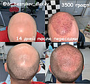 Трансплантация волос Алматы, фото 9