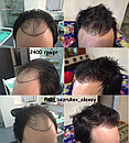 Трансплантация волос Алматы, фото 10