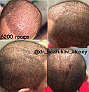Лечение выпадения волос у мужчин, фото 10