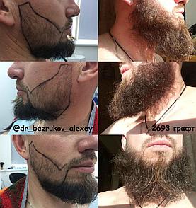 Пересадка волос на лицо