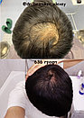 Пересадка волос методом фолликулярной экстракции в Алматы, фото 8