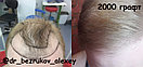 Бесшрамовая операция по пересадке волос в Алмате, фото 7
