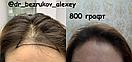 Безоперационная пересадка волос метод FUE в Алмате, фото 7