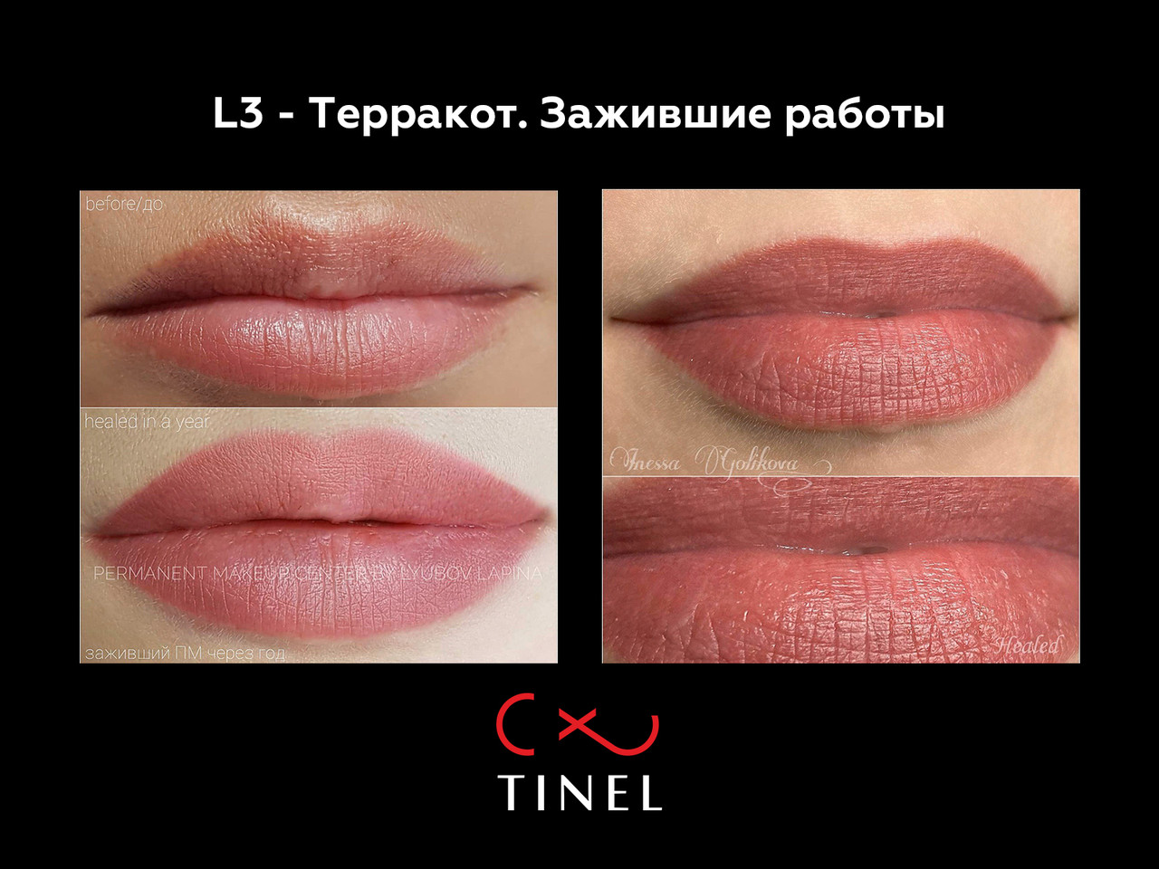 Тинель l8