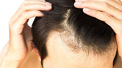 Пересадка волос методом FUE