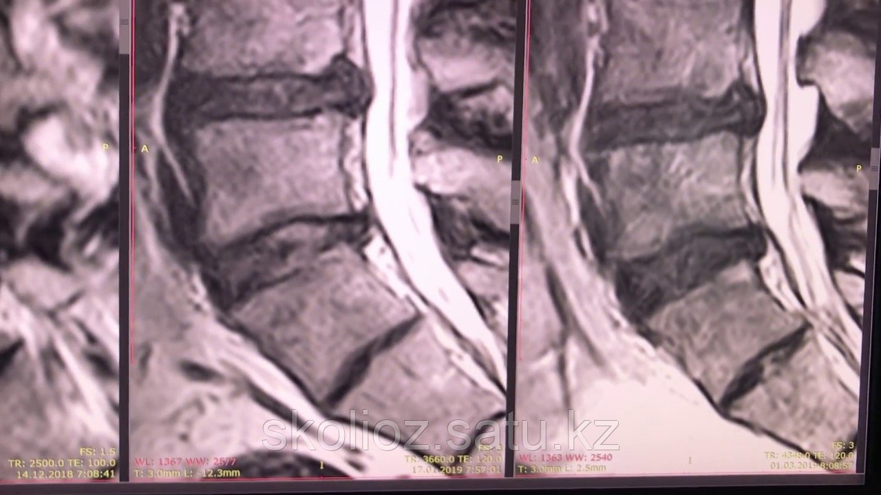резорбция межпозвоночной грыжи. резорбция межпозвоночной грыжи. резорбция грыжи межпозвонкового диска. грыжа межпозвоночного диска неврология. резорбция операция позвоночника.
