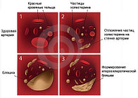 Атеросклероз. Комплекс №1,  3-х месячный курс.