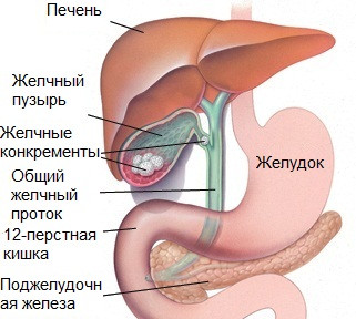 Желчнокаменная болезнь. Комплекс, 3-х месячный курс.