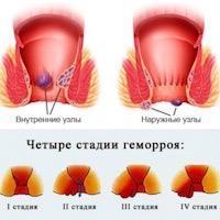 Средства для лечения геморроя