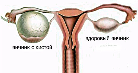 Кистоз яичников. Комплекс 1, 3-х месячный курс