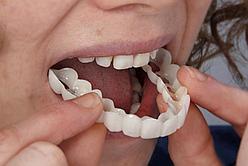 Виниры для эстетического протезирования зубов Snap On Smile
