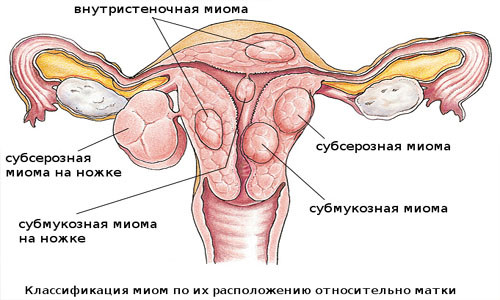 Миома, фибромиома матки. Комплекс 1, 3-х месячный курс.