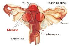 Миома, фибромиома матки. Комплекс 2, 3-х месячный курс.