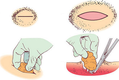 Удаление доброкачественных образований размером до  5,0 см или расположенное глубже подкожножировой клеточки