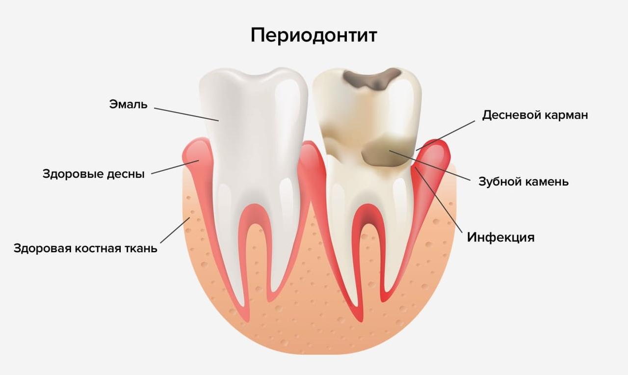 Лечение периодонтита фронтальных зубов/много корневые (хим)