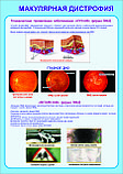 Плакаты Макулярная дистрофия, фото 3