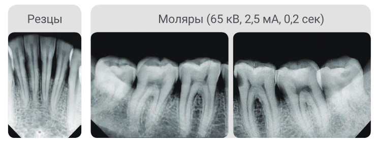 Аппарат рентгеновский дентальный портативный VEX P300 - фото 2 - id-p96924960