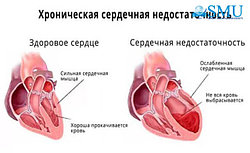 СЕРДЕЧНАЯ НЕДОСТАТОЧНОСТЬ: СИМПТОМЫ И МЕТОДЫ ЛЕЧЕНИЯ