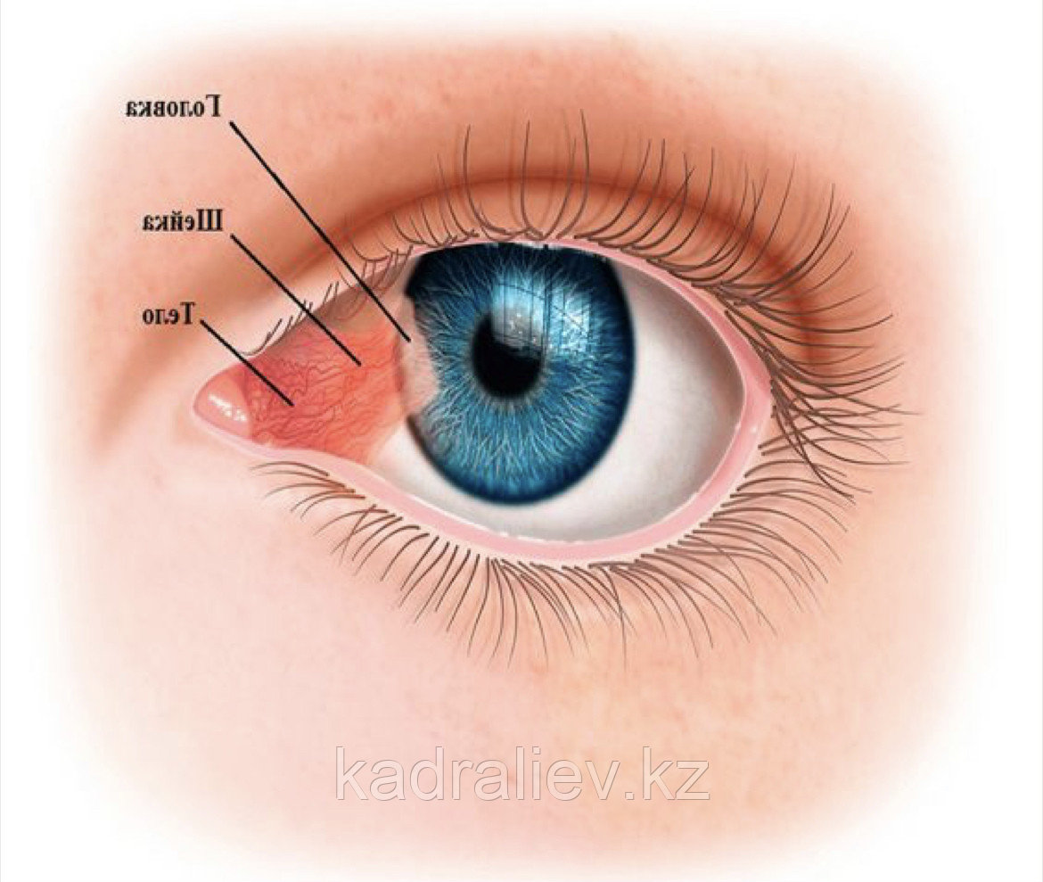 Почему вылазит глаз. Птеригиум коньюктивита. Птеригиум конъюнктивы пингвекула. Роговично-конъюнктивальный ксероз.