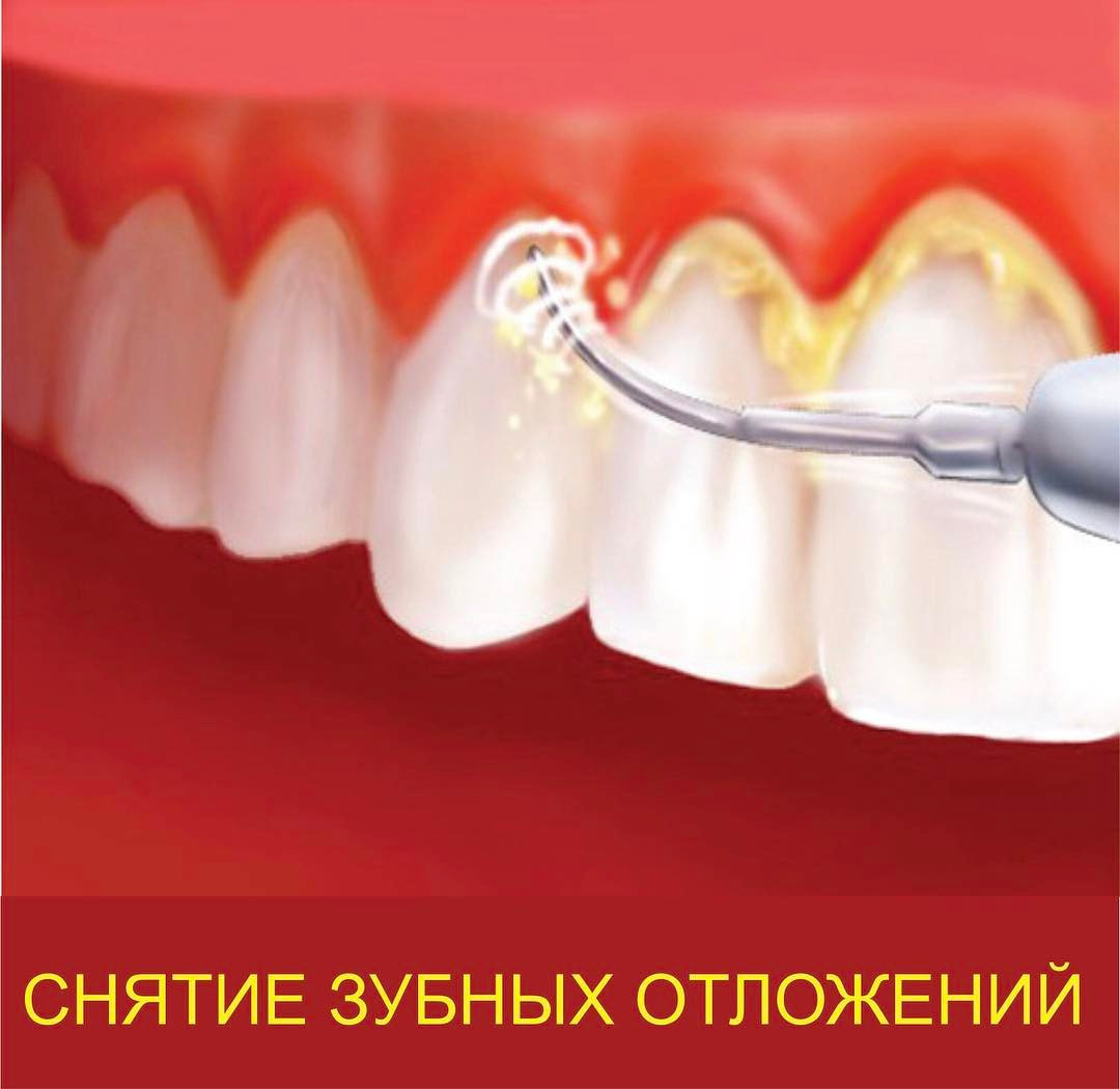 Ультразвуковая чистка зубного налета - фото 2 - id-p101489896