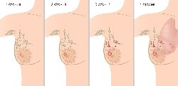 стадии рака молочной железы