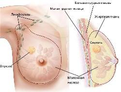 раковая опухоль в молочной железе