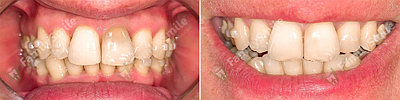 Лечение пульпита двух корневых зубов (1ед) (хим)
