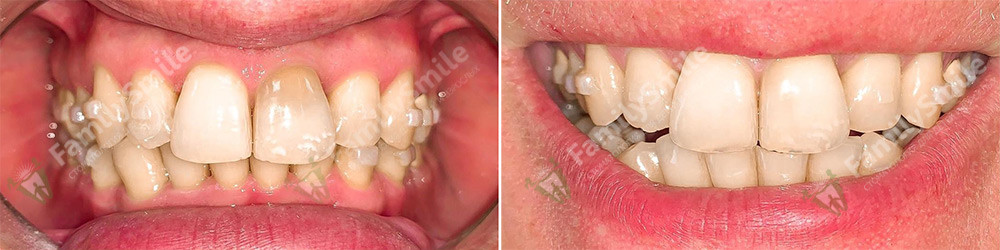 Лечение пульпита двух корневых зубов (1ед) (3М ESPE Filtek Ultimate)