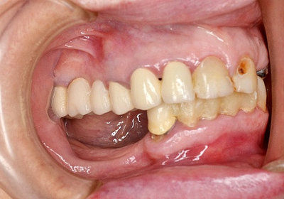 Лечение периодонтита фронтальных зубов/много корневые (хим)