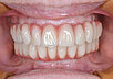 Лечение периодонтита фронтальных зубов/много корневые (хим), фото 2