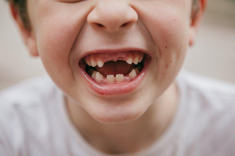 Удаление молочных зубов средней степени