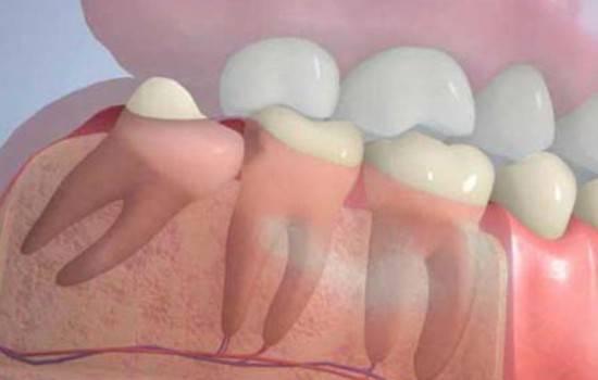 Удаление зуба - 8го зуба верхний сложный (зуб мудрости) (1ед) 9К