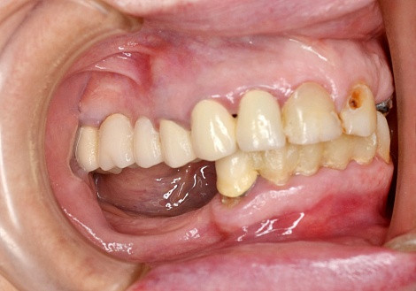 Удаление зуба - 8го зуба верхний (зуб мудрости) (1ед) 8К - фото 3 - id-p102783295
