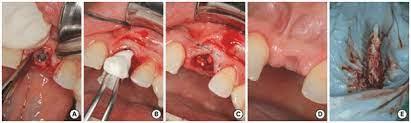 Удаление зуба - сложной степени сложности (1ед) - фото 1 - id-p102783294