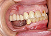 Удаление зуба - 8го зуба верхний сложный (зуб мудрости) (1ед) 9К, фото 5