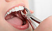 Удаление зуба - 8го зуба (зуб мудрости) (1ед) 8К, фото 8