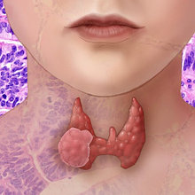 Первичные признаки рака щитовидной железы
