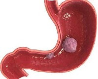 злокачественное новообразование в желудке