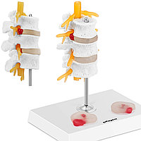 3D анатомическая модель поясничного отдела позвоночника с грыжами 3-5 позвонков