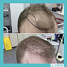 Пересадка волос у женщин в Алматы, фото 7