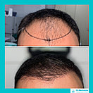 Пересадка волос у женщин в Алматы, фото 10